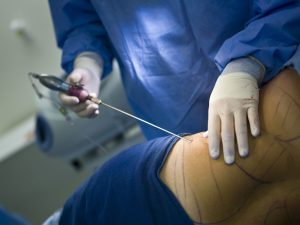 Iran Liposuction Cost