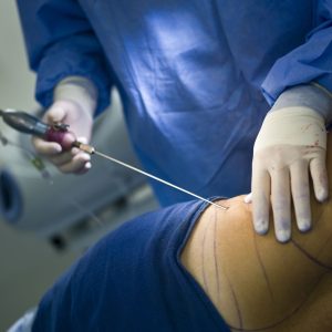 liposuction