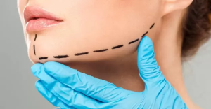 Chin Augmentation
