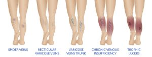 Varicose Veins stages