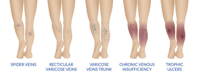 Varicose Veins stages