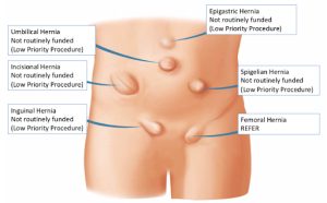 hernia treatment in iran