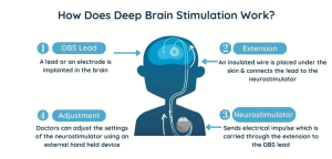 how does deep brain stimulation work