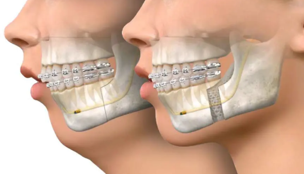 jaw surgery