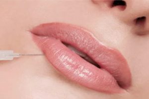 lip fillers