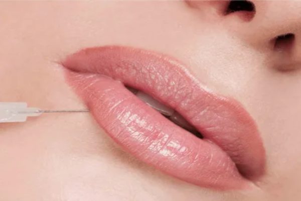 lip fillers