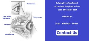 Orbital Decompression Surgery in Iran