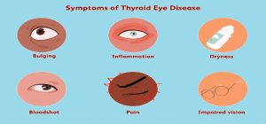 Symptoms of Thyroid Eye Disease 1